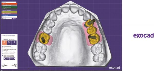 http://www.proteticke-komponenty.cz/images/exocad_cad_cam_knihovny.jpg