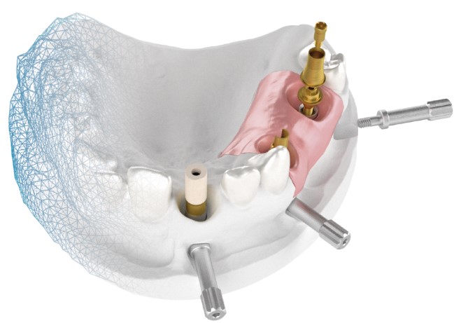 3D model digitálních analogů Ti-bází CAD/CAM IPD