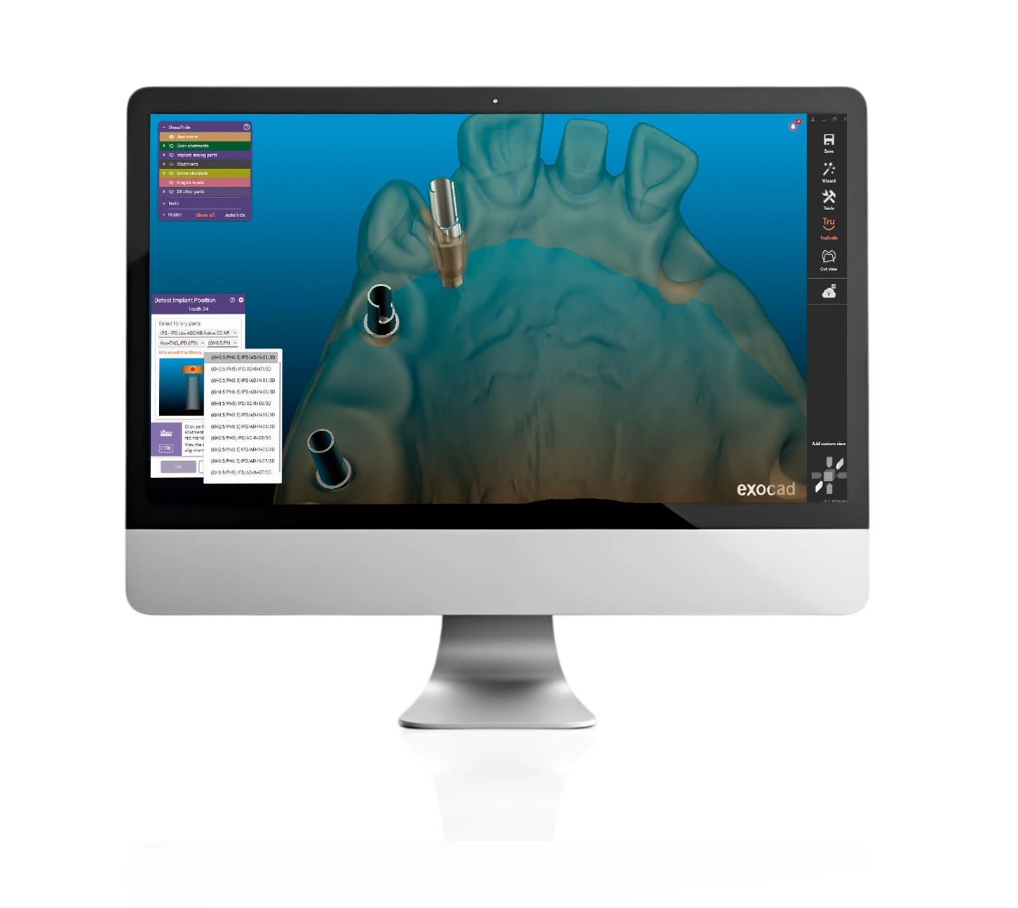 Ukázka detekce pozice implantátu v exocad workflow s IPD knihovnou