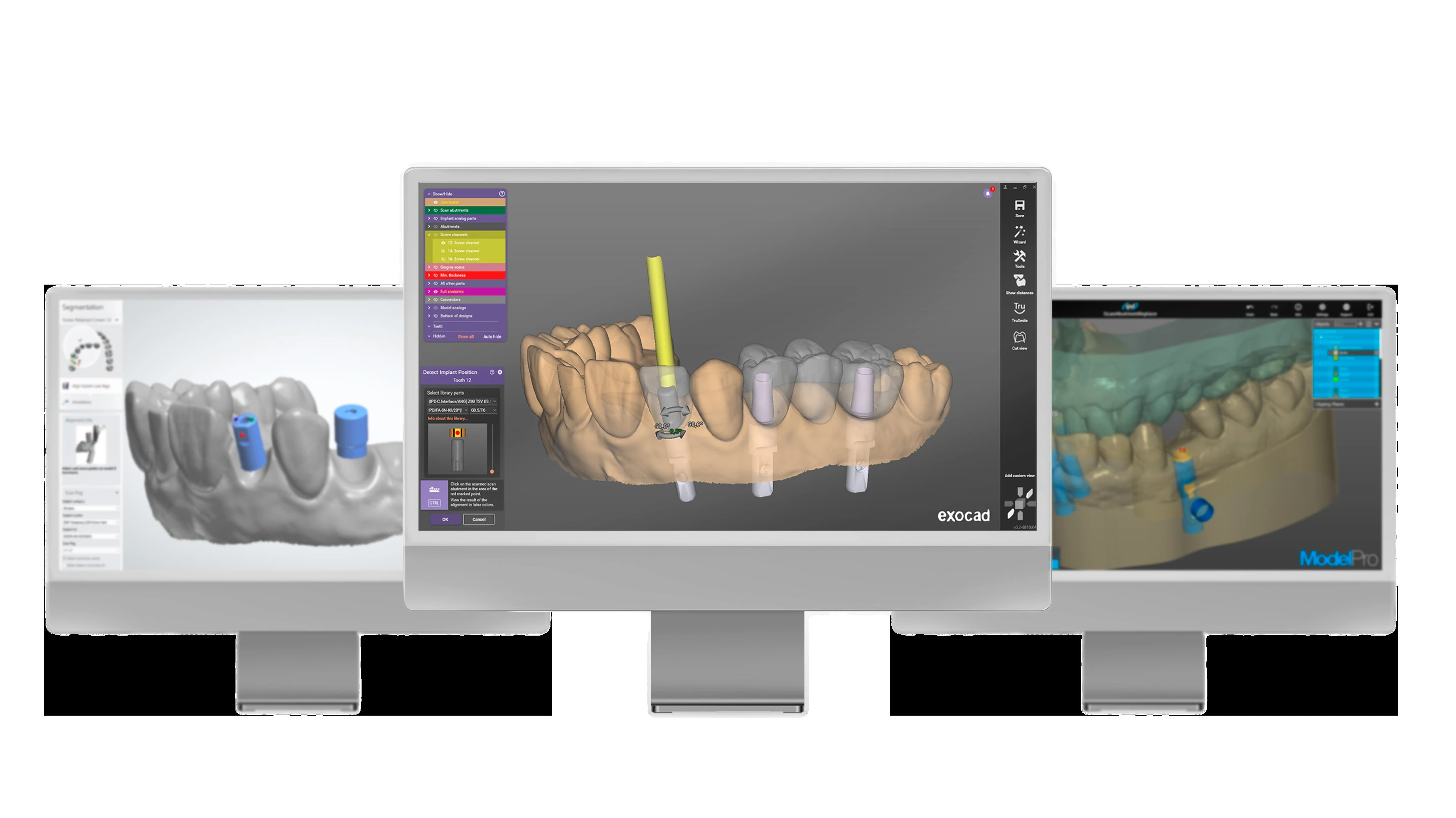 IPD software knihovny pro exocad, ModelPro a další CAD/CAM prostředí