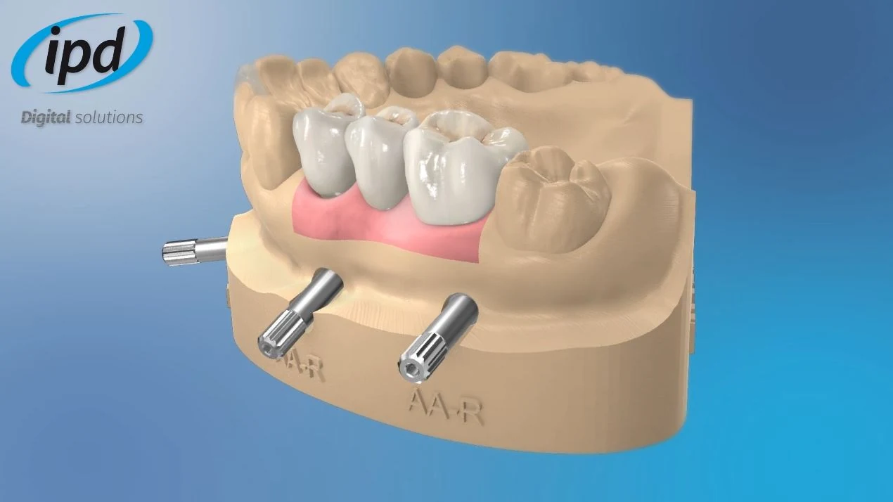 3D model s protetickým můstkem a digitálními analogy IPD