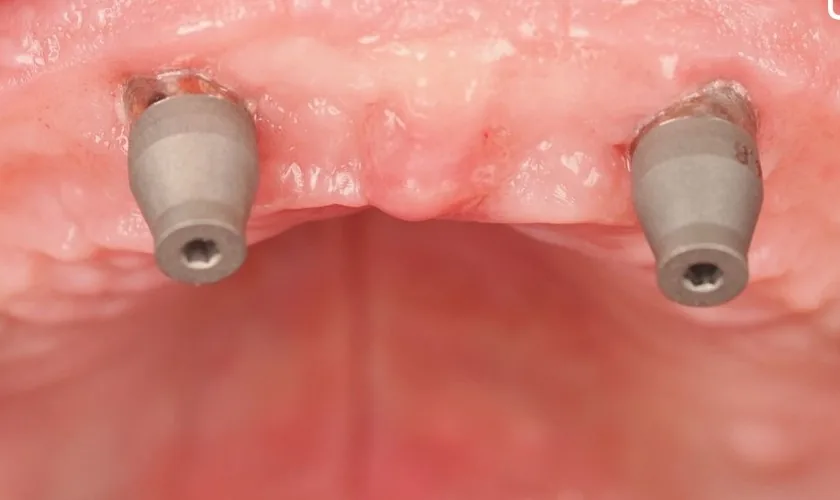 Initial clinical scan at MUA level before using Scan Flag iQ