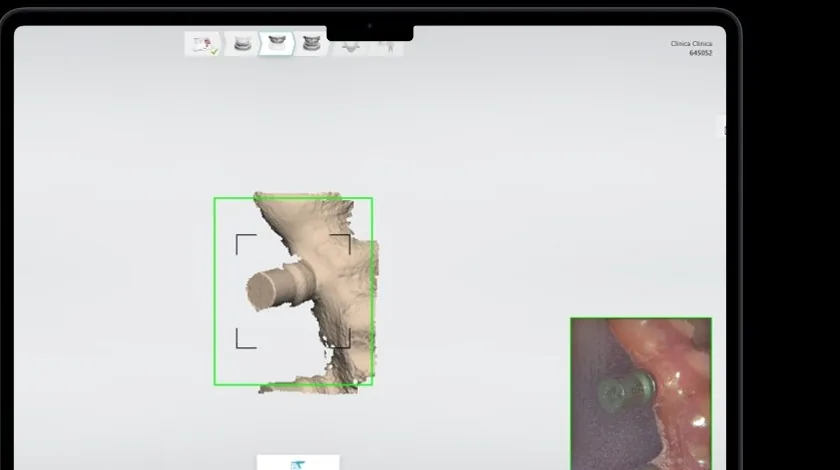 Reverse iQ and transfer of the provisional-restoration shape into the digital workflow