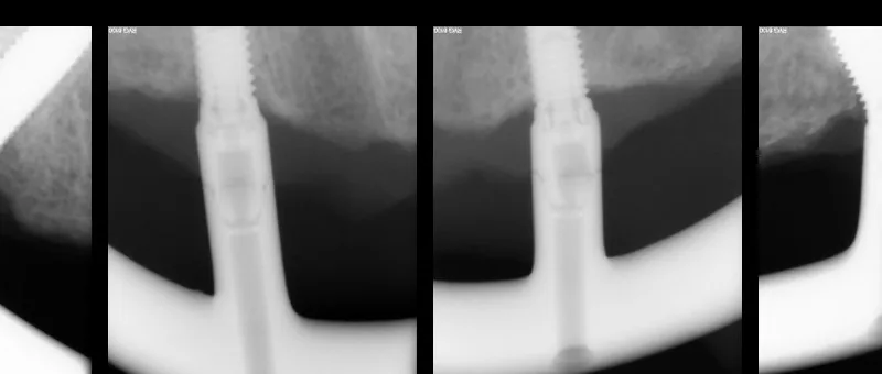 Radiographic verification of restoration passive fit after digital full-arch scanning