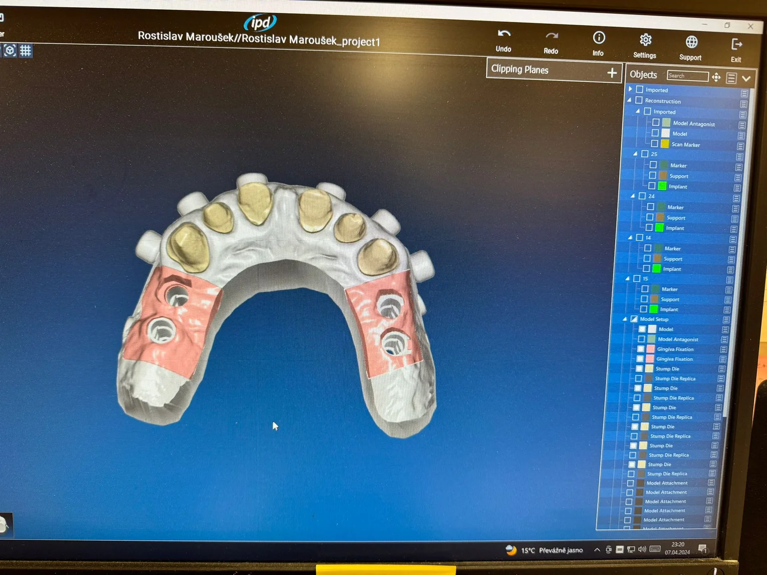 ModelPro – hotový digitální model s připravenými Stump Die 3D pahýly