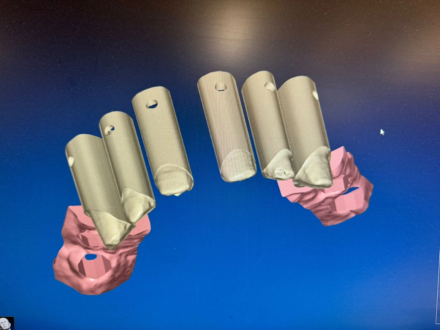 ModelPro – vyjímatelné pahýly Stump Die 3D v digitálním návrhu