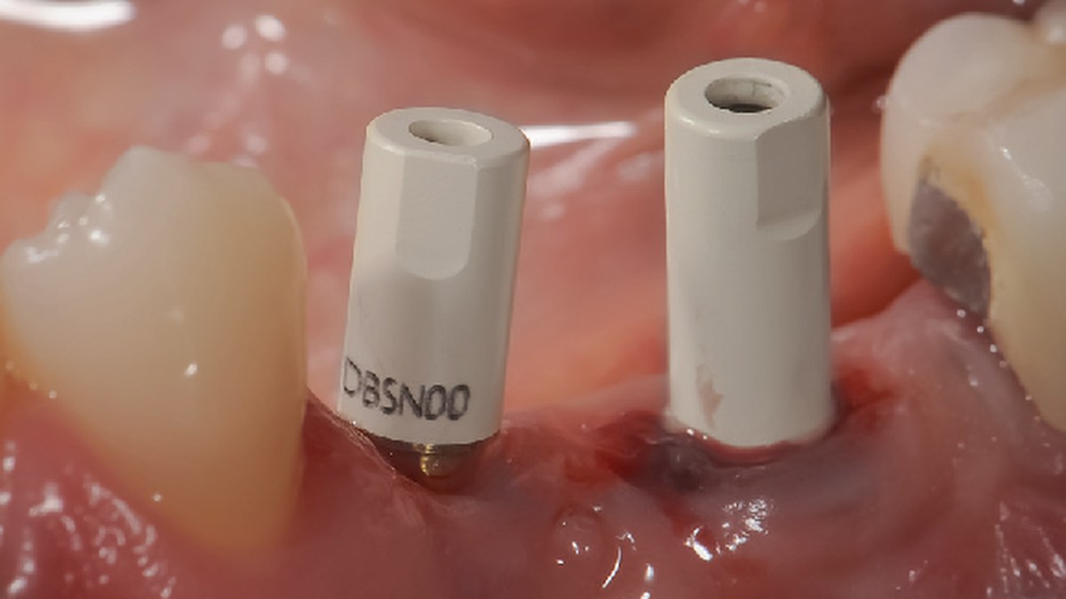 Různá implantátová spojení v jednom případu