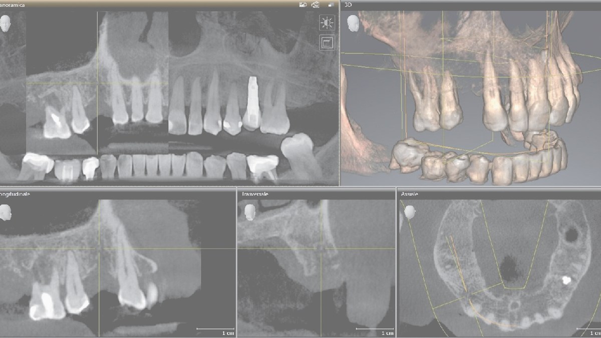 Implantoprotetika od CBCT po korunku