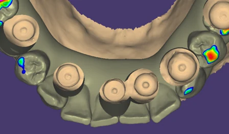 Digitální mapa referenčních ploch při skenování implantátů