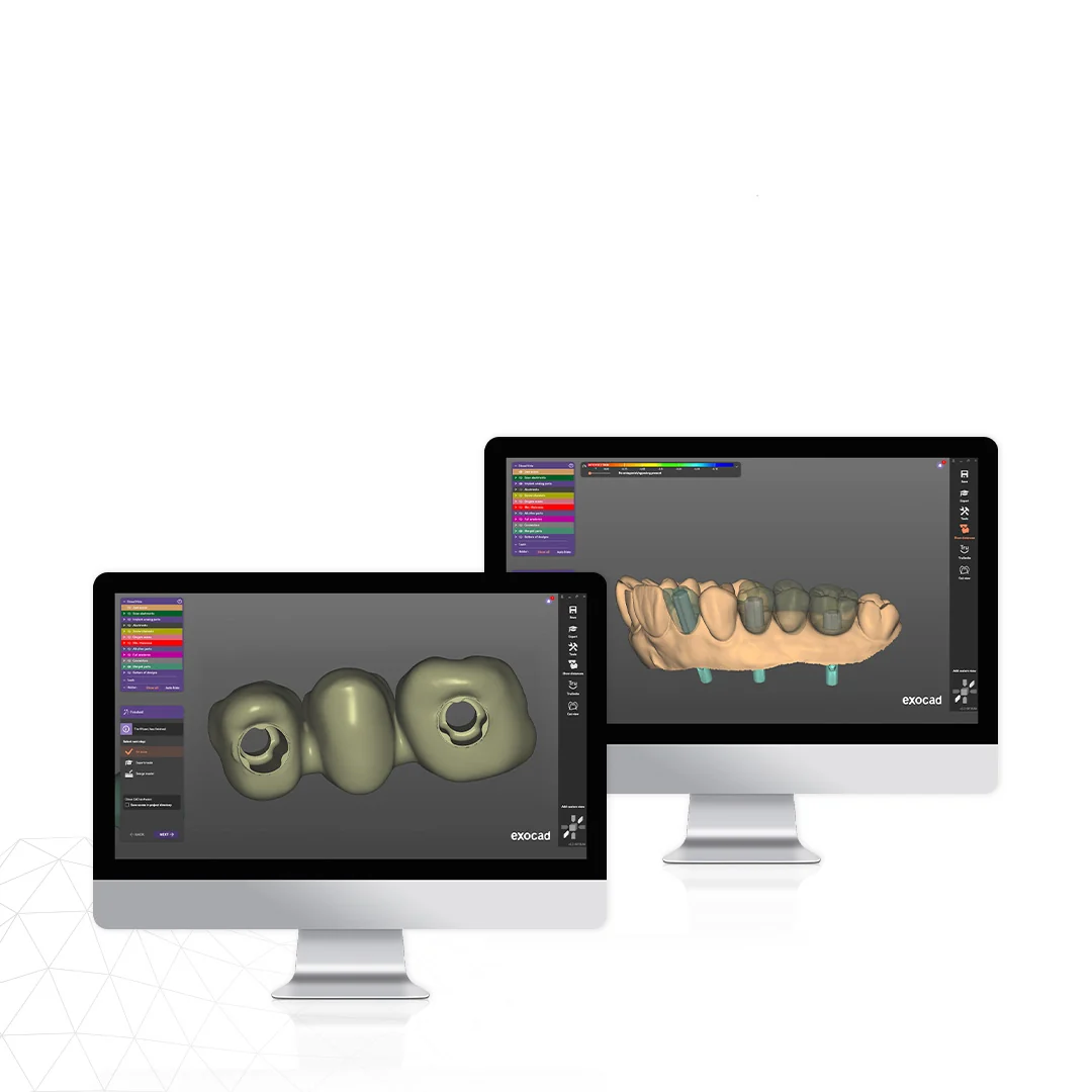 Digitální návrh provizorní restaurace na temporálních abutmentech IPD v CAD software